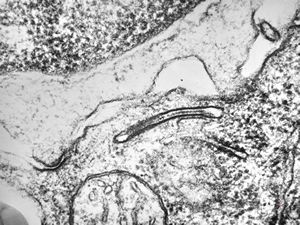 M,7m. | Birbeck granules (Langerhans granules, X-granules) - skin, histiocytosis X M,7m. | Birbeck granules (Langerhans granules, X-granules) - skin, histiocytosis X